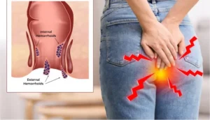 Causes of Piles