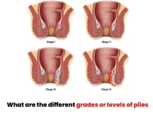 Types of Piles